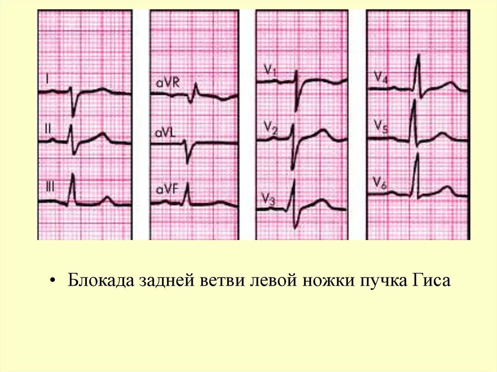 Блокада задней ножки. ЭКГ при блокаде задней ветви левой ножки. Блокада задней ветви ЛНПГ на ЭКГ. Блокада левой задней ветви на ЭКГ. Блокада ветвей левой ножки пучка Гиса на ЭКГ.