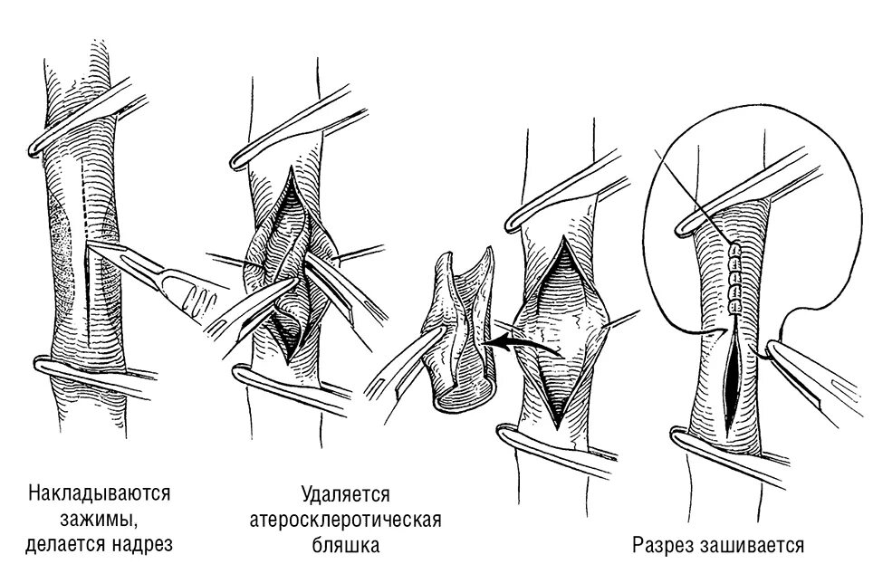 Каротидная эндартерэктомия. Операция каротидная эндартерэктомия. Эверсионная каротидная эндартерэктомия. Эверсионная каротидная эндартерэктомия слева что это. Эндартерэктомия это