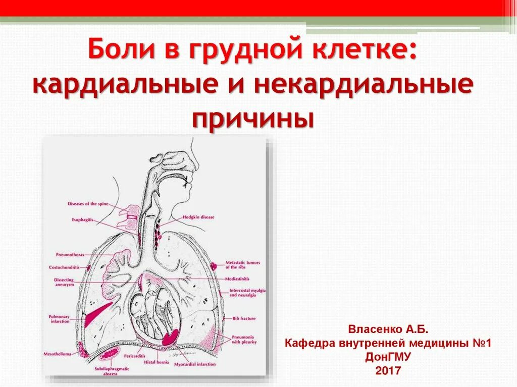 Боли под правой грудиной. Боль под грудной клеткой посередине спереди. Боль грудной клетки спереди слева. Боль справа в груди спереди. Боли в центре под грудной клеткой спереди.