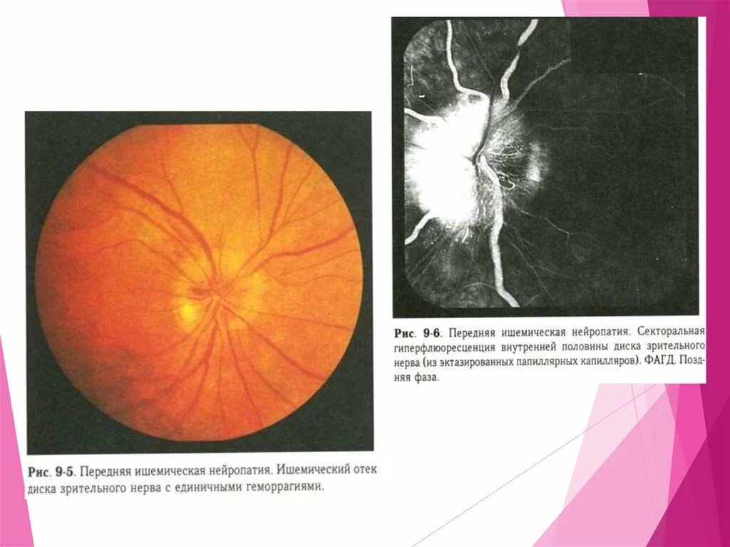 Нисходящая атрофия. Передняя ишемическая нейрооптикопатия зрительного нерва. Передняя ишемическая нейропатия глазное дно. Передняя ишемическая оптиконейропатия зрительный нерв. Ишемические нейропатии зрительного нерва.