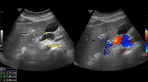 Портальная гипертензия на УЗИ. Расширение воротной вены на УЗИ печени. Тромбоз селезеночной вены на УЗИ. Расширение селезеночной вены