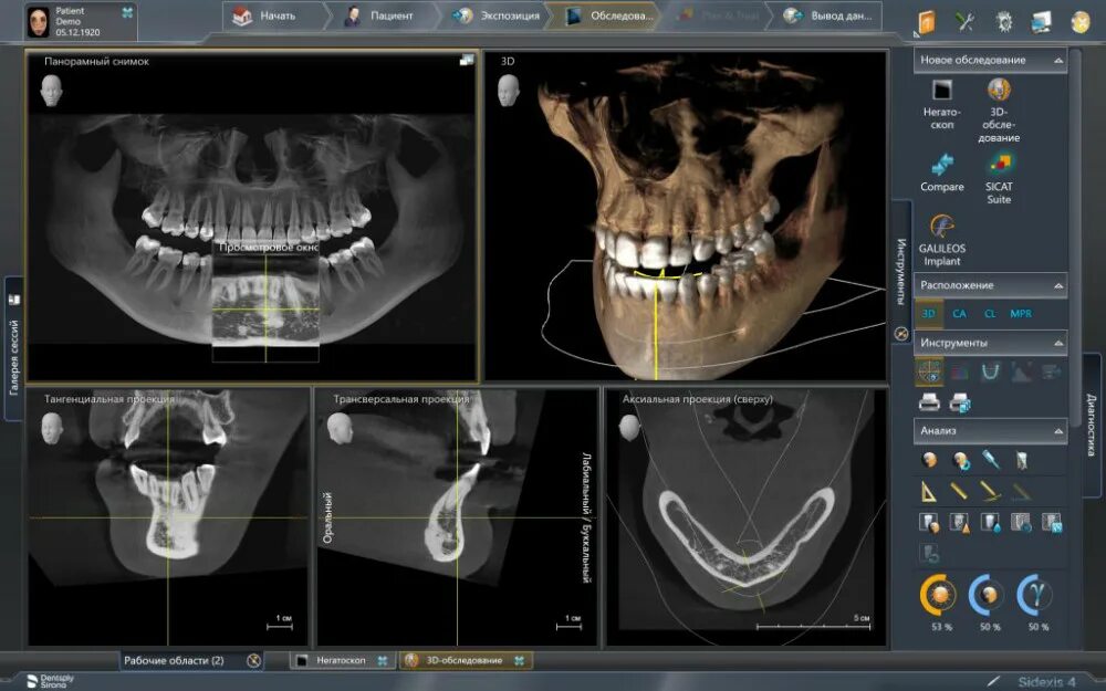 Где сделать кт зуба. Дентальная компьютерная 3d томография схема. КЛКТ SIDEXIS. SIDEXIS XG. Кт 15х15 верхней и нижней челюсти.