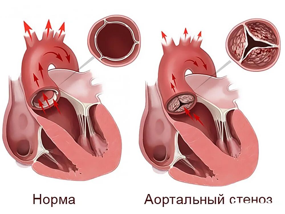 Аорта сердца фото. Стеноз аортального клапана. врожденный стеноз устья аорты. изолированный аортальный стеноз.