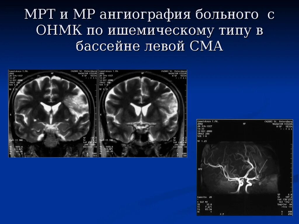 Инсульт правого бассейна. Мрт при ишемическом инсульте левой средней мозговой артерии. Ишемический инсульт бассейна левой средней мозговой артерии клиника. ОНМКПО имшемическому типу. Острое нарушение мозгового кровообращения по ишемическому типу.