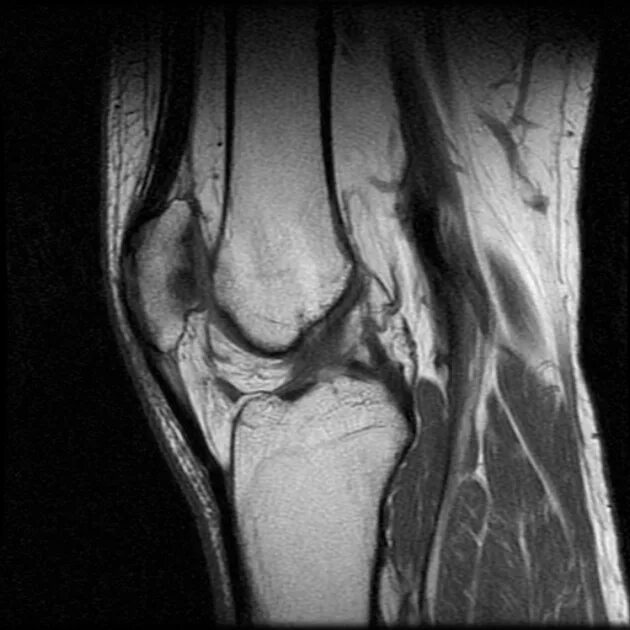 Хондромаляция надколенника Outerbridge. Хондромаляция коленного сустава мрт. Деструкции надколенника рентген. Хондромаляция коленного сустава что это. Хондромаляция медиальных мыщелков