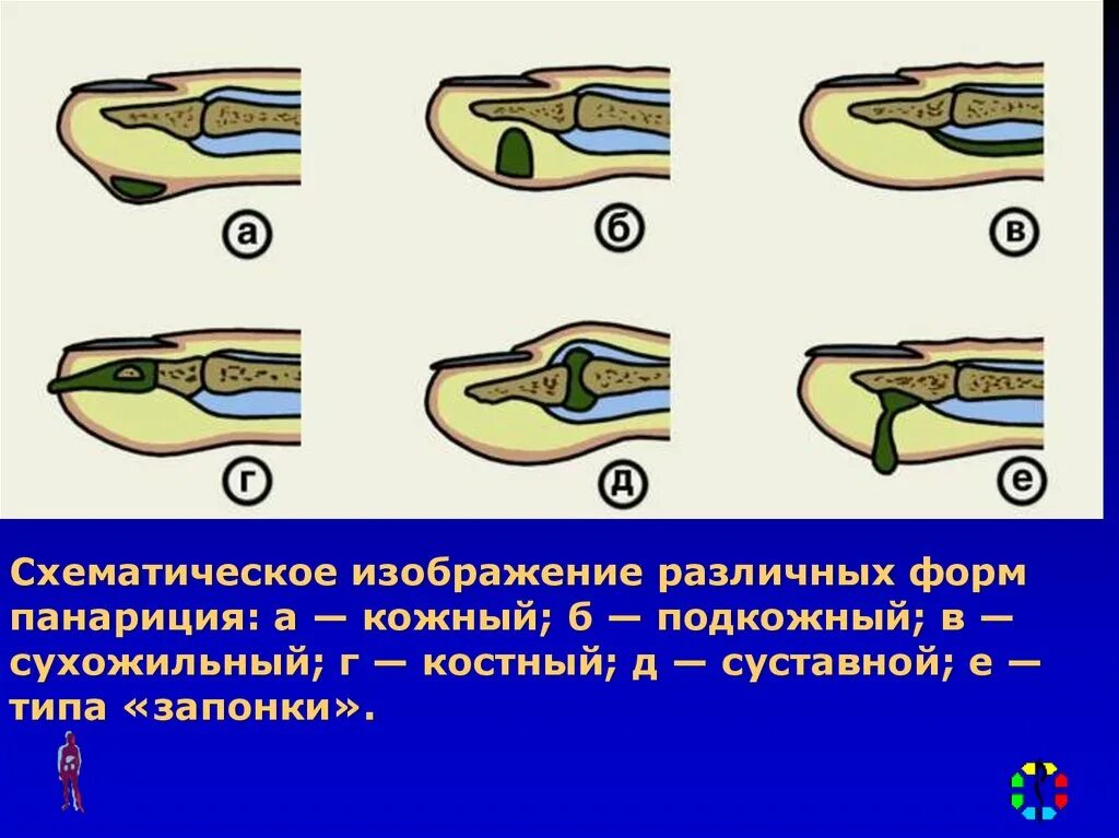 Что такое вскрылась. Подкожный панариций ногтевой фаланги. Околоногтевой панариций валика. Под ногтпвой панариций.