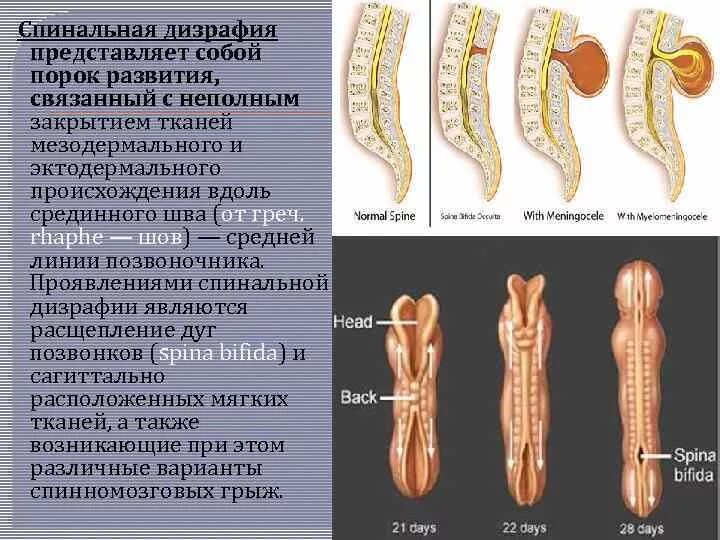 Аномалии развития нерва. Спинномозговая грыжа менингоцеле. Скрытый спинальный дизрафизм. Спинномозговая грыжа spina Bifida.