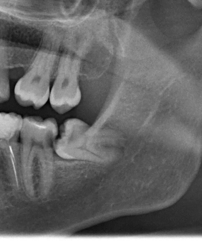 Зуб 8 нижний. Ретинированный зуб мудрости рентген. Полуретинированный зуб мудрости. Ретинированный верхний зуб мудрости.