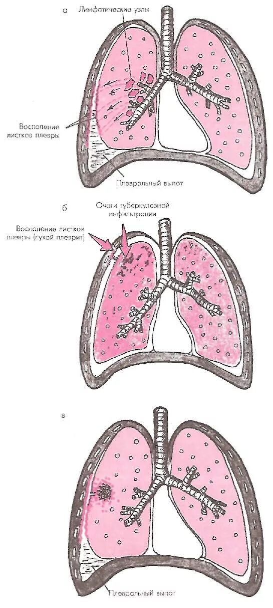 Туберкулезный плеврит (в т. ч. эмпиема). Туберкулезный экссудативный плеврит. Туберкулезный плеврит гистология. Плевральные осложнения
