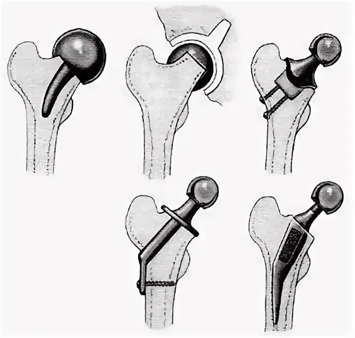 Эндопротез головки тазобедренного сустава. Эндопротез головки бедренной кости. Эндопротез тазобедренного сустава схема. Титановый тазобедренный эндопротез.