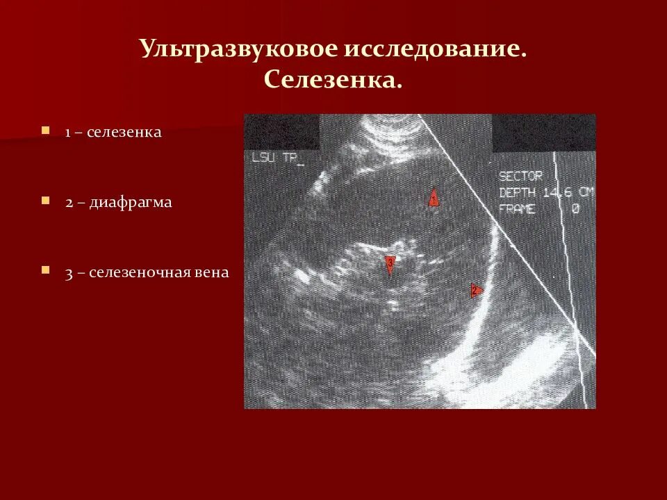 Патологии селезенки УЗИ норма. Объем селезенки на УЗИ В норме. Ультразвуковое исследование (УЗИ) селезенки. Площадь селезенки на УЗИ норма.