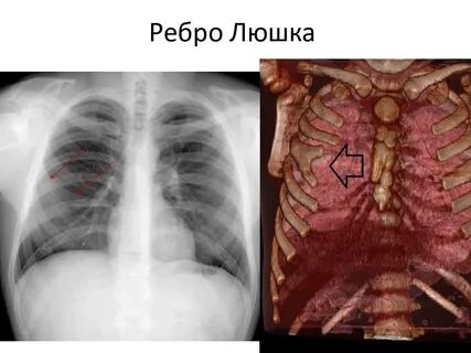 Ребро люшке