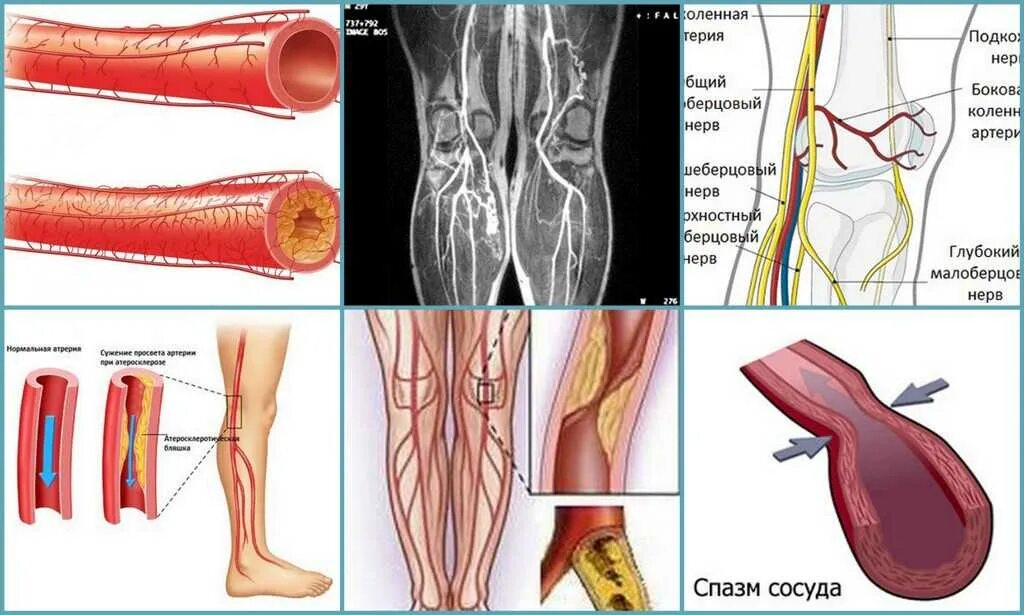 Облитерирующий атеросклероз сосудов нижних конечностей. Облетерический атеросклероз и эндартериит. Облитерирующий атеросклероз сосудов ног. Облитерирующий атеросклероз голени. Сужение сосудов симптомы причины