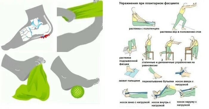 Сильные боли после перелома. Плантарный фасциит стопы лечебная гимнастика. Упражнения при подошвенном фасциите. Лечебная гимнастика для пяточной шпоры. Упражнения лечебной физкультуры при пяточной шпоре.