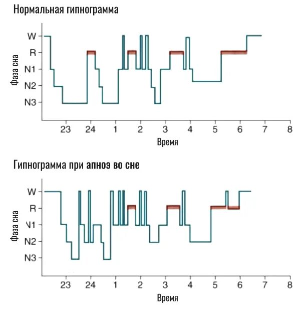 Гипнограмма. Нормальная гипнограмма. Гипнограмма здорового человека. Гипнограмма цикла сна.