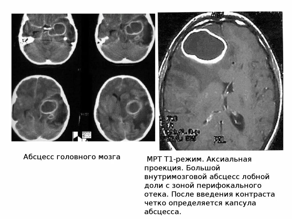 Образование в лобной доле. Кт при абсцессе головного мозга. Абсцесс головного мозга кт. Абсцесс лобной доли мозга кт. Внутримозговой абсцесс кт.