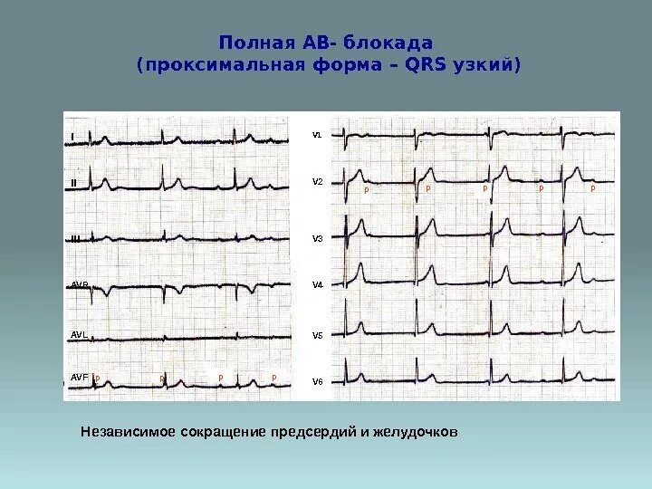 Что значит полная блокада. Полная АВ блокада на ЭКГ. Полная av блокада на ЭКГ. ЭКГ при АВ блокаде. Полная атриовентрикулярная блокада на ЭКГ.