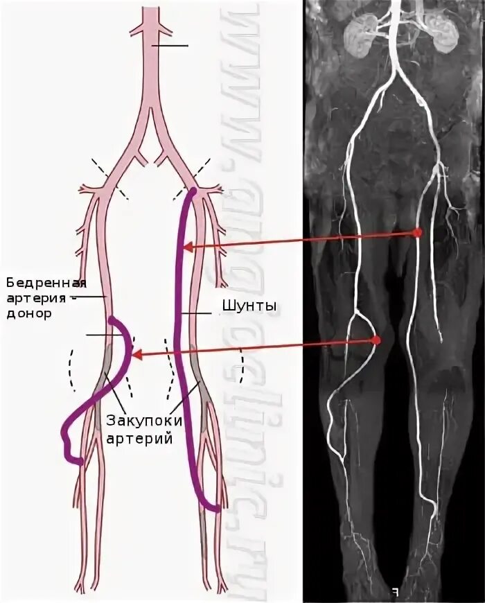 Шунтирование артерий нижних конечностей. Шунтирование бедренно подколенной артерии. Операция бедренно подколенное шунтирование. Операция шунтирование артерий нижних конечностей. Шунтирующие операции на артериях нижних конечностей.