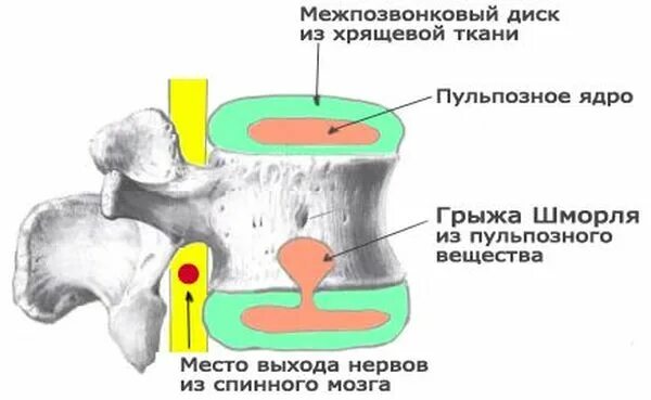 Узлы шморля в грудном отделе что это. Грыжи шморля th5-th12. межпозвоночная грыжа шморля поясничного отдела. узлы шморля в позвоночнике что это.