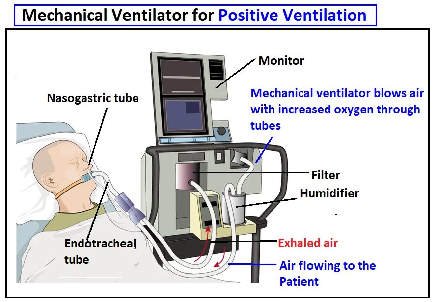 Mechanical Ventilation. Volume Control Ventilation. Ventilator vte9271. Vap tpu ru