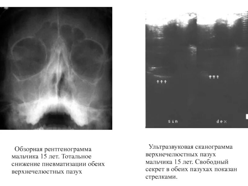 Локальное утолщение слизистой. Тотальное снижение пневматизации левой верхнечелюстной пазухи. Снижение пневматизации верхнечелюстных пазух на рентгене. Понижение пневматизации левой лобной пазухи. Снижение пневматизации лобных пазух рентген.