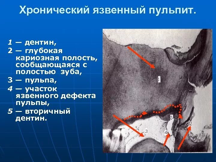 Кариозная полость сообщается с полостью зуба