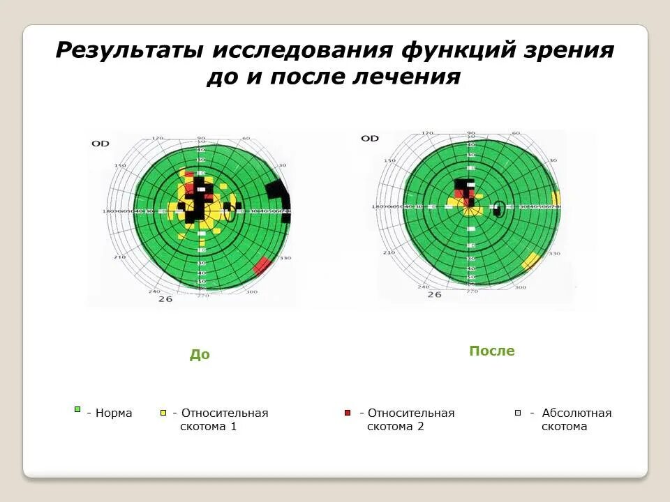 Периметрия поля зрения норма. Расшифровка компьютерной периметрии полей зрения. Компьютерная периметрия норма. Поле зрения скотома и норма.