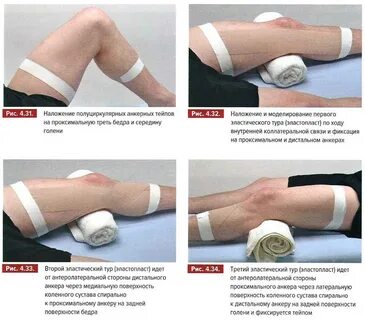 Тейпирование при травме коленного сустава