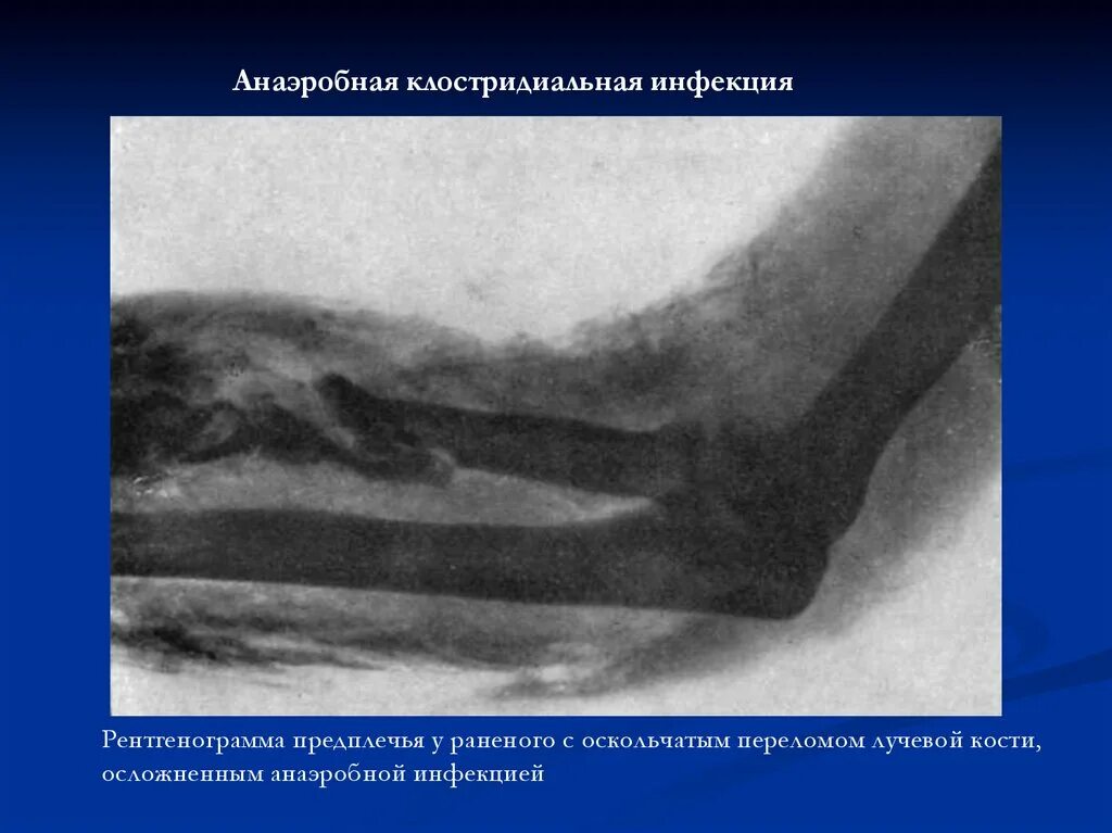 Гнойные заболевания кисти. Гнойные заболевания костей