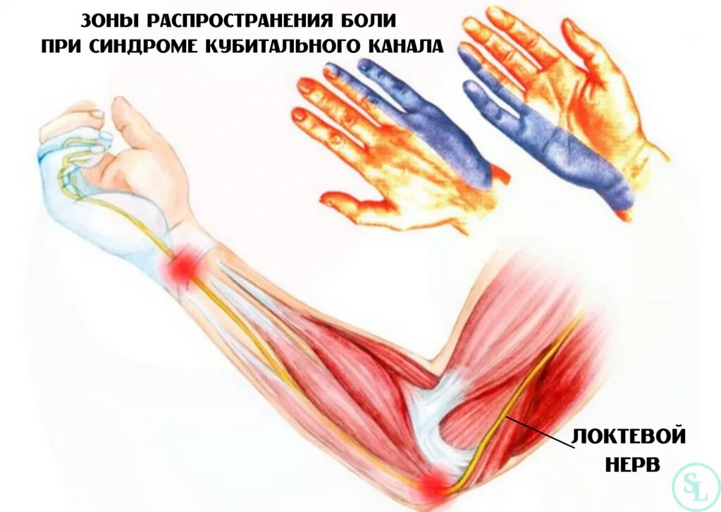 После операции немеют пальцы. Синдром кубитального канала локтевого нерва. Кубитальный канал локтевого нерва анатомия. Туннельный синдром локтевого нерва. Туннельный синдром компрессии локтевого нерва.