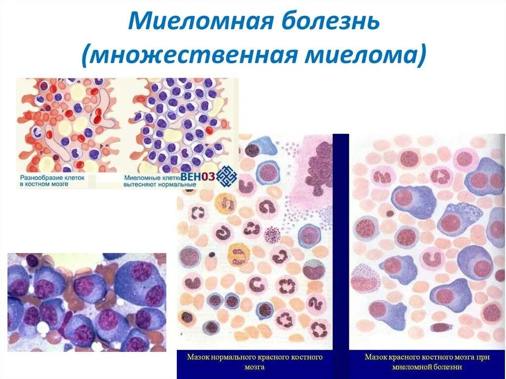 Костный мозг какие заболевания. Множественная миелома картина крови. Миеломная болезнь (плазмоцитома).. Миеломная болезнь клинические рекомендации 2022. Патанатомия миеломной болезни.