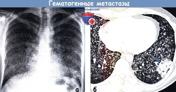 Почему метастазы в легких. Гематогенные метастазы в легких на кт. мелкоочаговые метастазы в легких. метастазы в легких рентгенограмма.