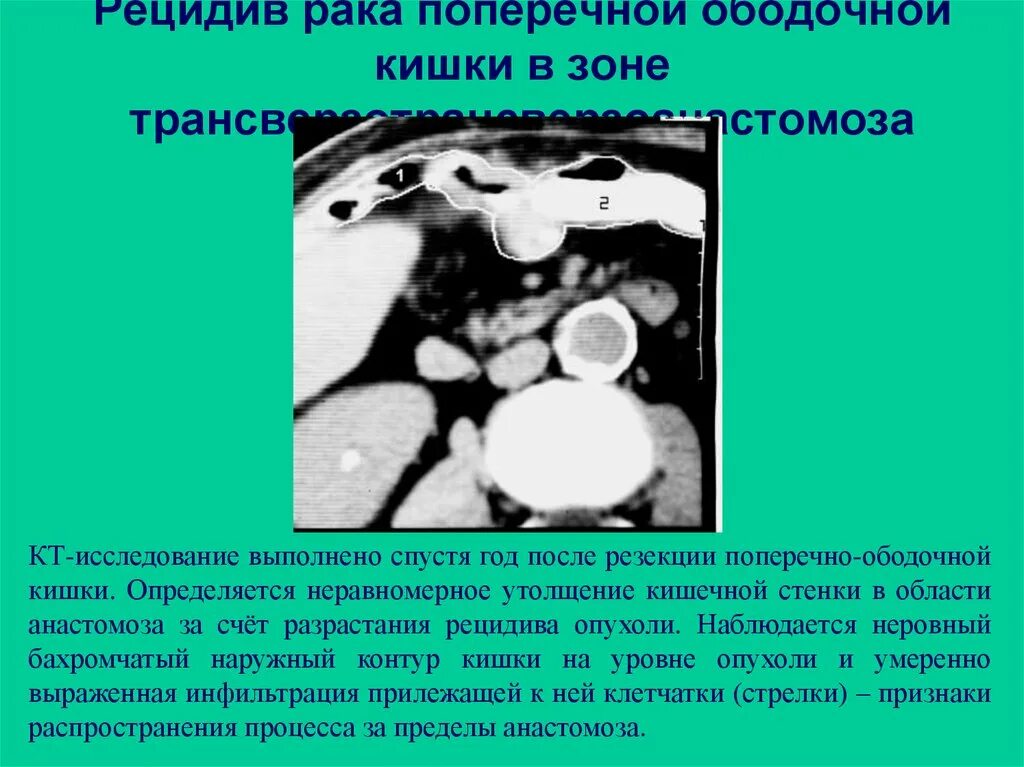 Рецидивирование опухоли. Рецидивирование это в онкологии. Рецидив кишечника