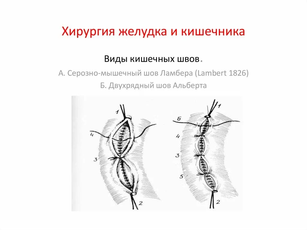 Операция желудка кишечника