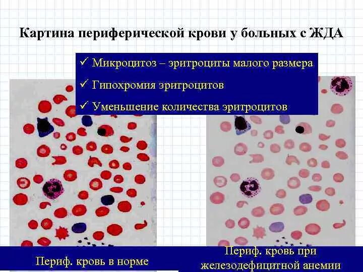 Постгеморрагическая анемия показатели крови. Картина крови при железодефицитных анемиях патфиз. Кровь при железодефицитной постгеморрагической анемии. Картина крови при железодефицитной анемии патофизиология.