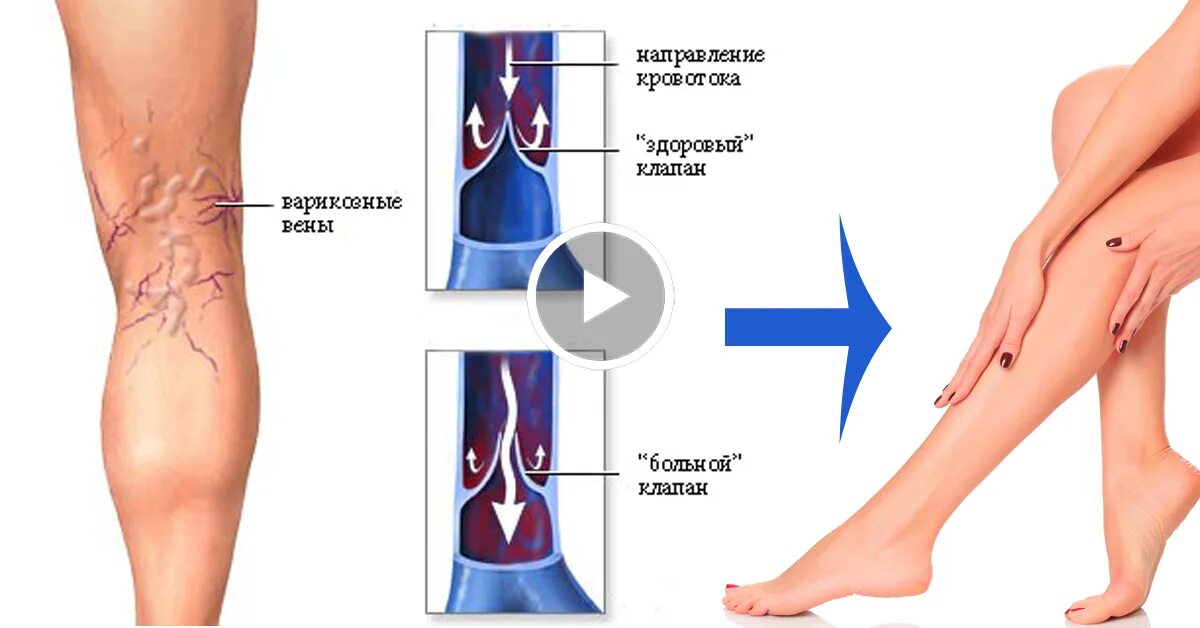 Варикозное расширение вен. Варикозно расширенные вены. Венозное расширение вен. Что значит расширение вен