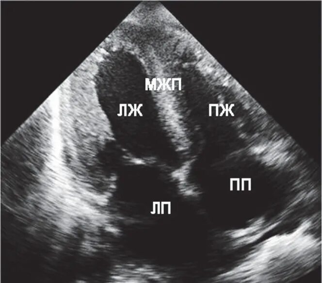 Диффузные изменения лж. Гипертрофия левого желудочка на УЗИ. Эхо кг гипертрофия левого желудочка. Эхокардиография гипертрофия левого желудочка. Гипертрофия левого желудочка на ЭХОКГ.