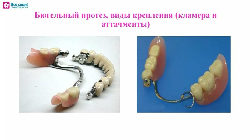 Этапы изготовления бюгельных. Бюгельный протез замковый с аттачменах. Бюгельный протез с кламера. Бюгельный протез с аксиальными аттачменами. Бюгельный протез на аттачменах и клямерах.