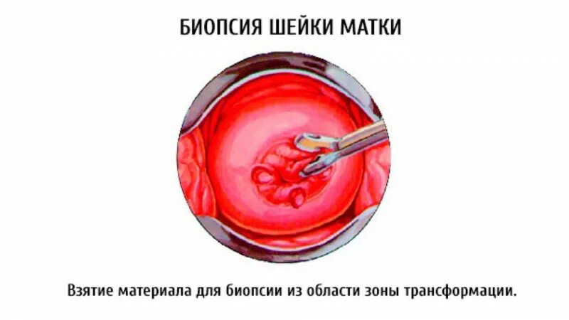 Что такое биопсия шейки матки. Прицельная биопсия шейки матки инструменты. инструмент для взятия биопсии шейки матки. панч биопсия шейки матки. для взятия биопсии шейки матки используются:.
