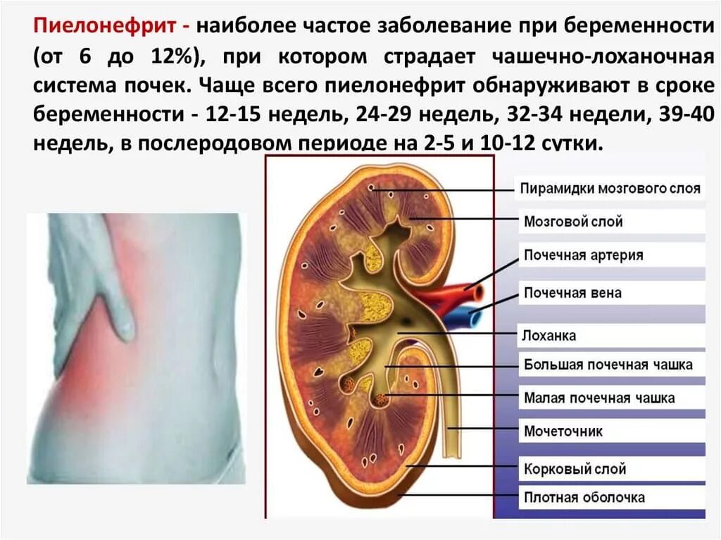 Мочеточник беременность. Пиелонефрит (инфекционное поражение почек). Чашечно лоханочная система при пиелонефрите. Пиелонефрит почек при беременности.