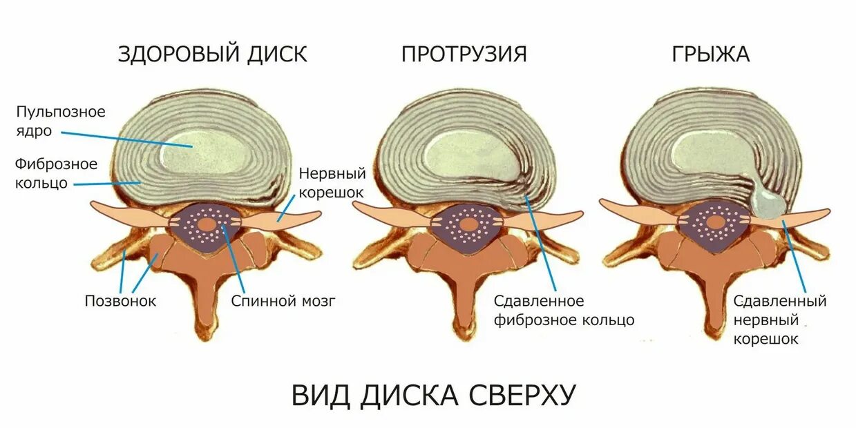 Содержимое межпозвоночного диска. Грыжа диска и протрузия диска. Протрузия грыжа межпозвонковых дисков. Протрузии дисков с4-th1. Протрузия и грыжа диска отличие.