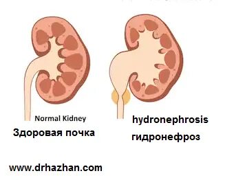 Расширение члс обеих почек