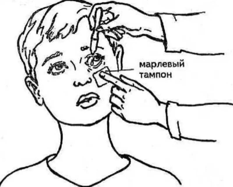 Алгоритм закладывания в глаза. Закапывание капель в глаза детям. закапывание капель в глаза детям алгоритм. введение глазных капель алгоритм. алгоритм ребёнку закапывания глаз:.