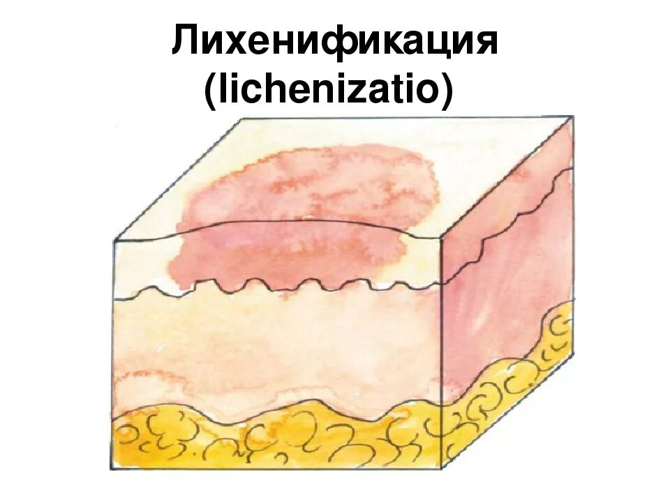 Слизистые покровы или гладкая поверхность. Вторичные элементы сыпи лихенификация. Вторичные морфологические элементы кожи лихенификация. Лихенификация морфологический элемент. Элементы кожной сыпи лихенификация.
