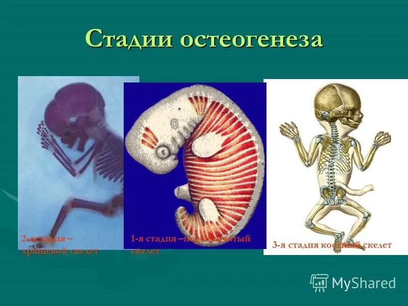 Нарушения развития скелета. Нарушения развития скелета
