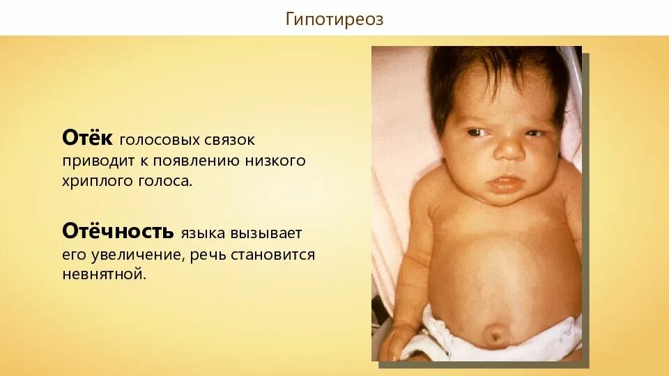 Гипотиреоз лечение препараты. Врожденный гипотиреоз у детей. Средство при гипофункции щитовидной железы. Гипотиреоз симптомы микседема. Гипоториоз.