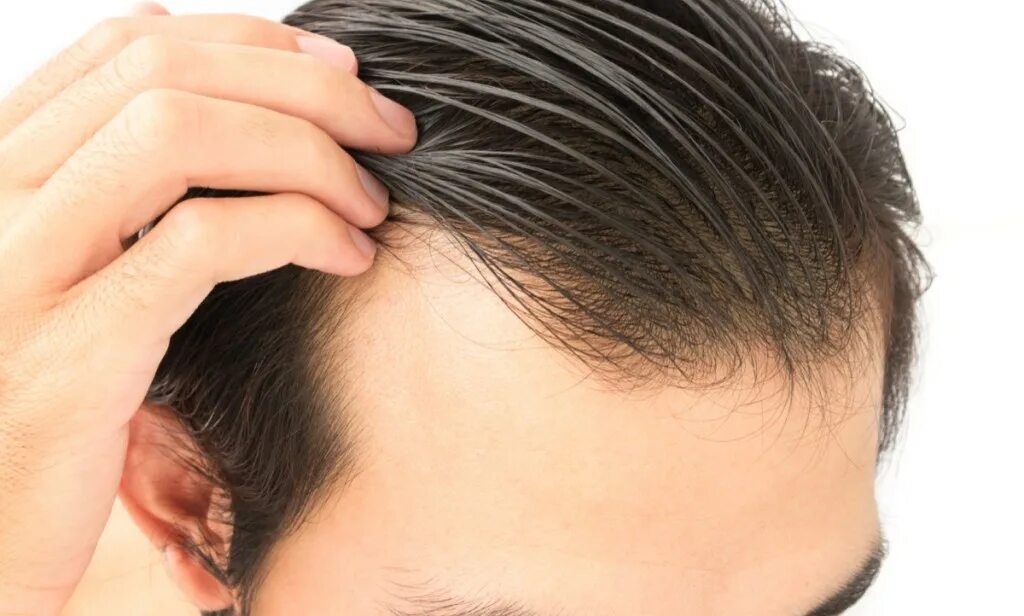 Проблема выпадают волосы. Выпадение волос у мужчин. Линия роста волос у мужчин. Стрижка при выпадении волос мужская. PRP терапия для волос у мужчин.