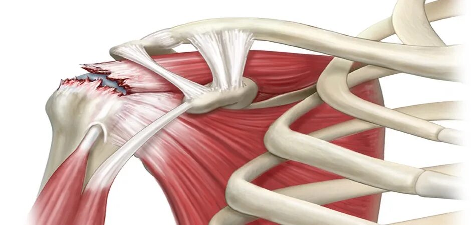 Разрыв надостной мышцы лечение. Сухожилие ротаторная манжета. Сухожилие надостной мышцы. Отрыв сухожилия дельтовидной мышцы. Отрыв сухожилия надостной мышцы.