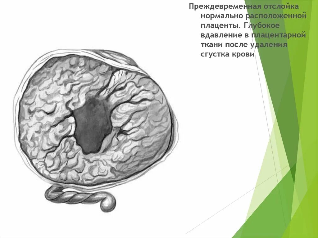 Ретроплацентарная гематома. Преждевременная отслойка плаценты. Ретроплацентарная гематома что с маткой.