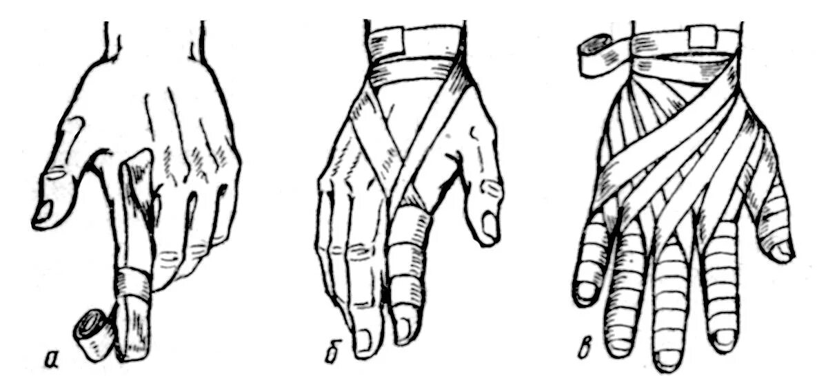Повязка на руку схема. Перевязка кисти эластичным бинтом. Перевязка бинтом перчатка. Бинтование Рыцарская перчатка. Схема бинтования пальца.